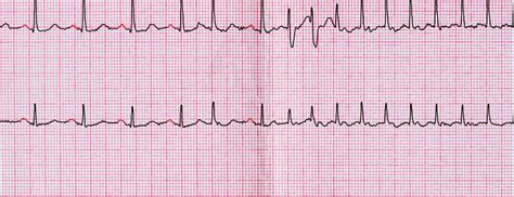 Heart Rhythms Whats Normal Versus Cause For Concern Johns Hopkins