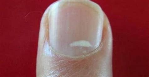 Review Of Why Are White Spots Appearing On My Nails References Fsabd42
