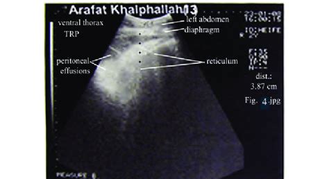 Ultrasonogram In A Heifer With Traumatic Reticuloperitonitis Showed