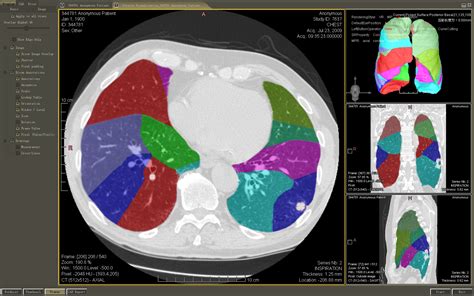 Wtsa Pre Operative Three Dimensional 3 D Lung Segmental