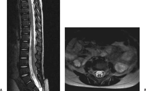 Tethered Spinal Cord Syndrome Pictures