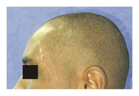 Clinical Preoperative Aspect Scar On The Temporal Region Download
