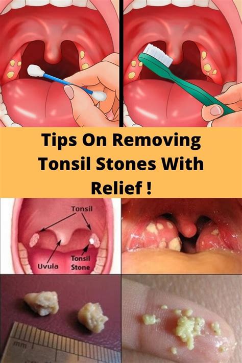 How To Remove Tonsil Stones From Throat How To Do Thing