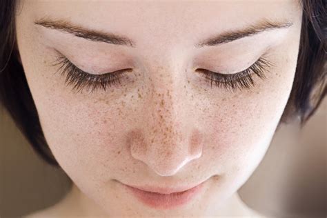 10 Of The Best Methods For Freckles Treatment Healthwire
