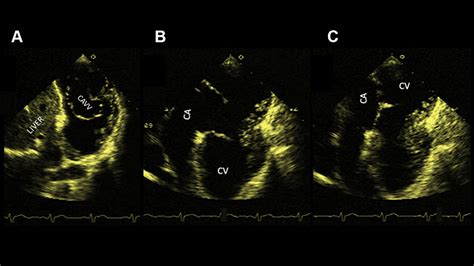 A Two Dimensional Transthoracic Echocardiogram In Subcostal View