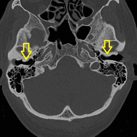 External Auditory Canal Exostoses Radiology Reference Article