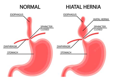 Hiatal Hernia Symptoms Complications And Treatment Dr Datta Ram