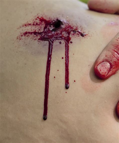 Wounds may be clean or contaminated and dirty, superficial or deep and penetrating. Gunshot Wound Clavicle (Right) - Techline Technologies, Inc.