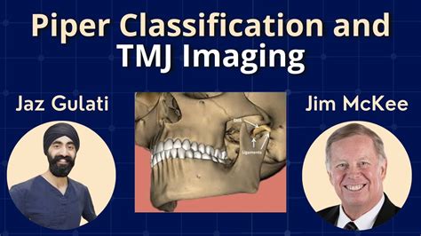 Piper Classification And Tmj Imaging With Dr Mckee Pdp080 Spear
