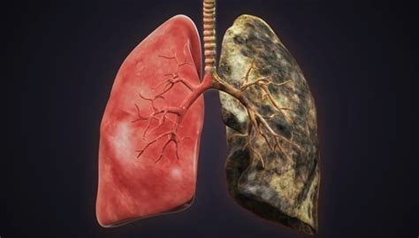 See This Is What Your Lungs Look Like When You Smoke Health24