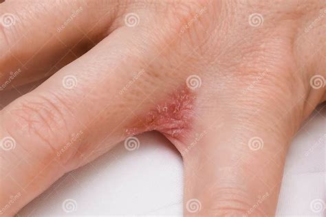 Hand With Interdigital Dermatitis Dyshidrotic Eczema On Hand Close Up