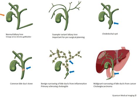 Mrcp The Fine Art Of Imaging The Pancreato Biliary Tree Quantum