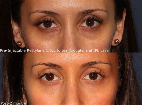 Eye Rejuvenation Cosmetic Laser Dermatology Skin Specialists In San Diego