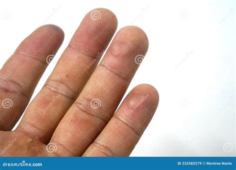 Blisters On The Tip Of The Ring Finger And Little Finger Stock Image