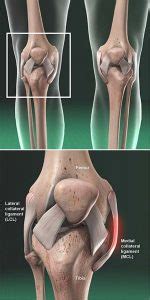 Lesión del ligamento colateral mediano MCL Grupo médico ortopédico