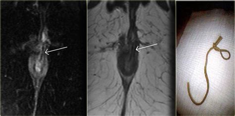 Role of transcutaneous perianal ultrasonography in evaluation of fistulas in ano. The Radiology Assistant : Rectum - Perianal Fistulas