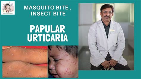Insect Bite Papular Urticaria Mosquito Bite Dr Chandrashekar Bs