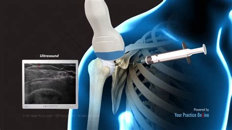 Intraarticular Shoulder Injection Youtube