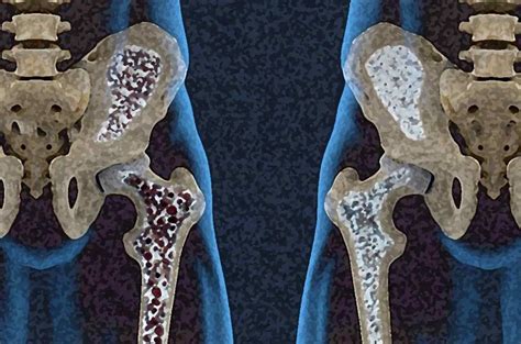 Esto Es Lo Que Debes Saber Acerca De La Osteoporosis