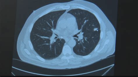 Check Up 13 Low Dose Ct Scan Detects Lung Cancer Early In Some