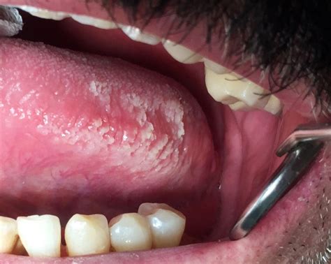 Oral Hairy Leukoplakia On The Lateral Border Of The Tongue With