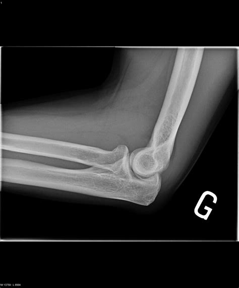 Coude Brise Broken Elbow X Ray Radiology Radiologie Elbow Flickr