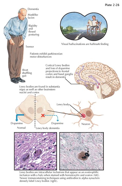 Dementia With Lewy Bodies Pediagenosis
