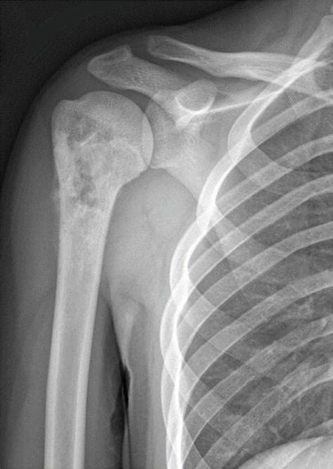 Shoulder Surgery For Bone Tumors Intechopen