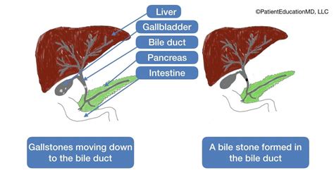 Stones In The Bile Duct Bile Duct Duct Bile Stone