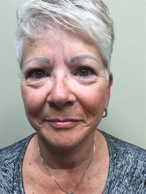 Patient B 12 Weeks Post Operative Face Lift Frontal Image — Dr