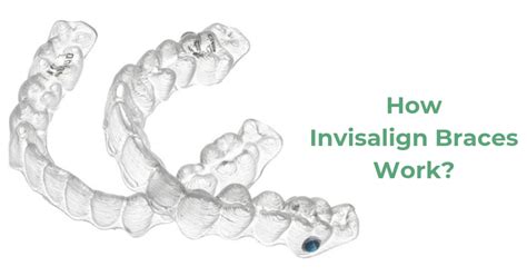 How Invisalign Braces Work Teeth And Braces Clinic Indore