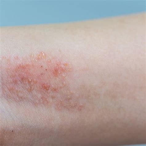 Ease Your Itchy Skin With These 8 Best Eczema Treatments Prevention