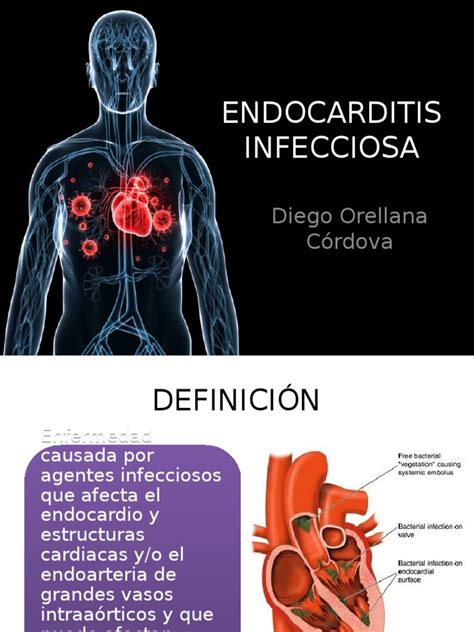 Endocarditis Infecciosa Enfermedades Y Trastornos Salud Pública