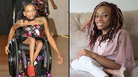 Woman With Spina Bifida Hits The Catwalk Shake My Beauty Gentnews