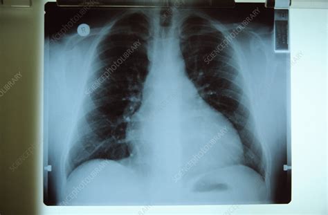 Enlarged Heart X Ray Stock Image M1720541 Science Photo Library