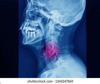 Cervical spondylosis is extremely common. Cervical Spondylosis Images, Stock Photos & Vectors ...