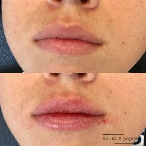 Pin by danielle smith np on botox & filler danielle smith np | Botox fillers, Botox, Danielle smith
