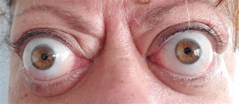 Chronic Thyroid Eye Disease Before And After Tepezza Teprotumumab Trbw