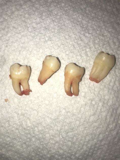 Just Had My Wisdom Teeth Removed Teethwalls