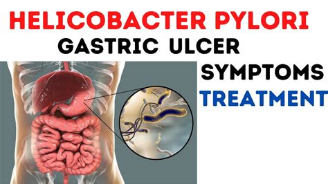 Helicobacter Pylori Infection Pathogenesis Treatment YouTube