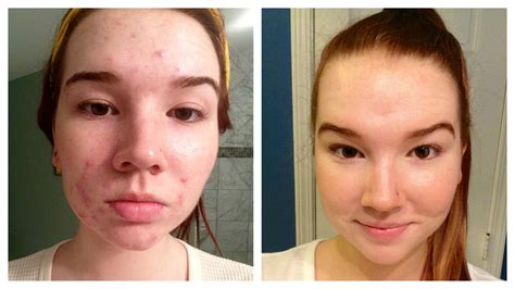 How I Cleared My Acne Before After Pictures Youtube