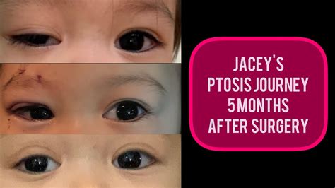 Congenital Ptosis Jaceys Ptosis Journey 5 Months After Surgery