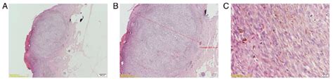 Representative Histology Images Of Nodular Melanoma A Scale Bar 500