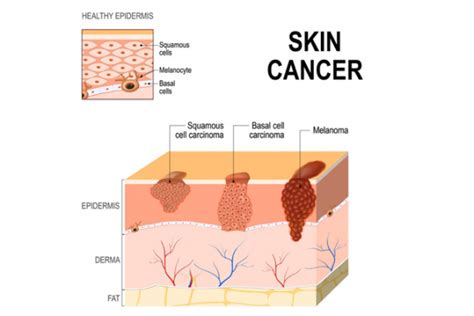 Squamous Cell Carcinoma Scc Healthify