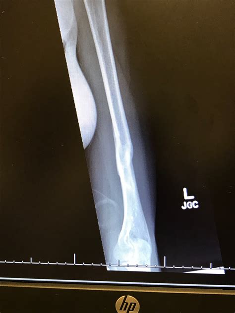 A Broken Humerus — Road To Recovery By Maddie Wirthman Medium