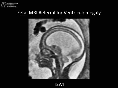 Fetal Mri Referral For Ventriculomegaly American Society Of Pediatric