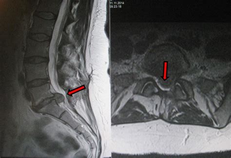 Bandscheibenvorfall in der brustwirbelsäule (bws): Bandscheibenvorfall | Vulpius Klinik