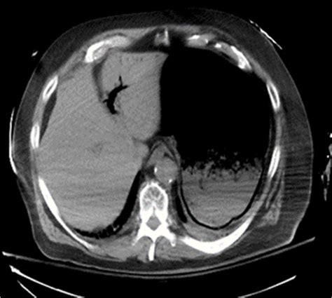 Figure 2 Ct Scan Of Abdomen Demonstrating Gastric Pneumatosis And