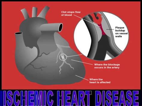 Ischemic Heart Diseaseppt