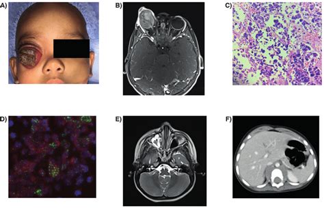 A Clinical Presentation Of Patient 1 Denoting A Fungating Mass In The